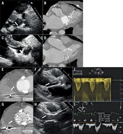neila sayah|Alcohol septal ablation preceding transcatheter valve implantation .